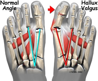 ayak-basparmak-cikintisi-halluks-valgus-bunyon-deformitesi-1337.jpg